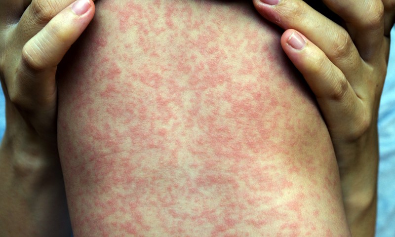 Rising Measles Cases Spark Travel Warning Across Europe